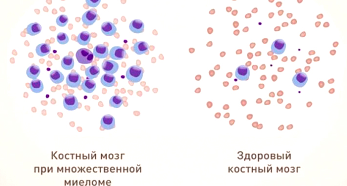 стадии при миеломе