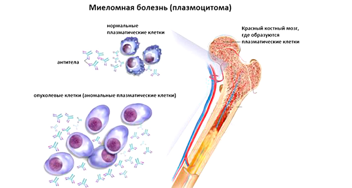 виды миеломы