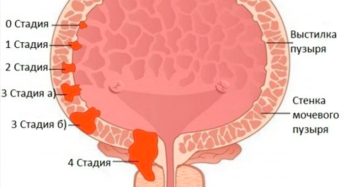 стадии онкологии мочевого пузыря