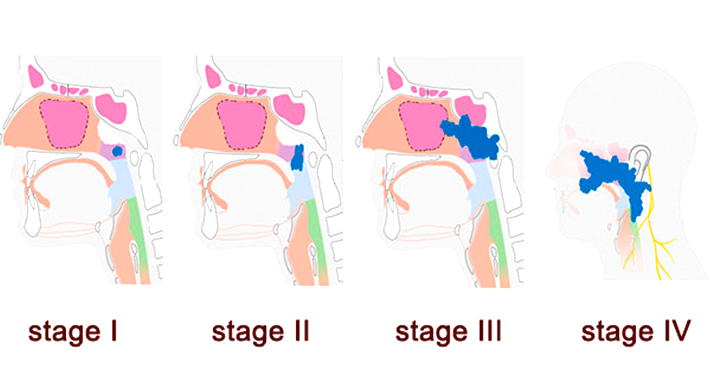 Стадии рака носоглотки