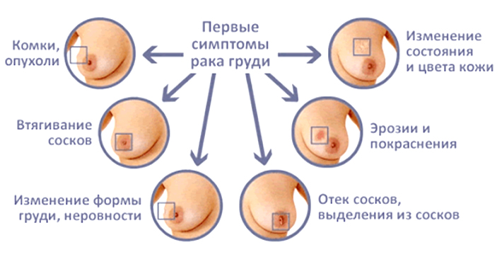 Признаки рака молочной железы