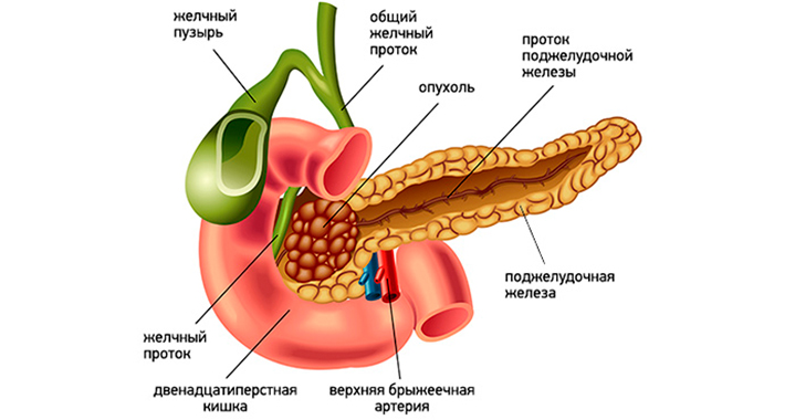 Опухоль влияет на функции поджелудочной железы