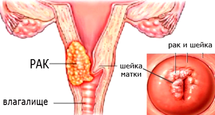 саркома шейки матки