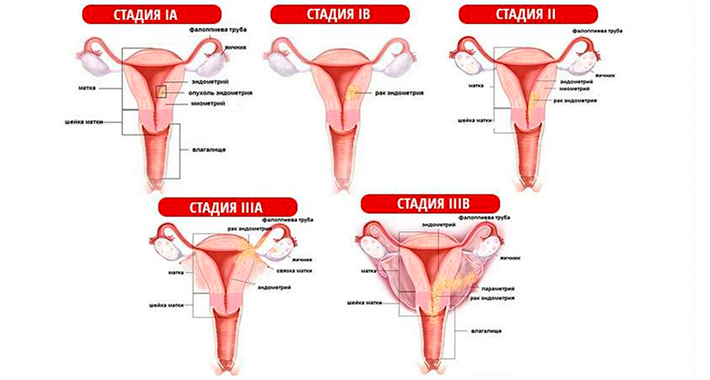 Стадии рака шейки матки